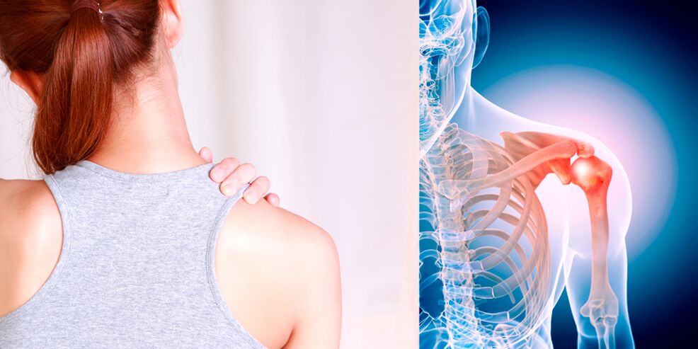 Omuz osteoartritinin gelişimi yavaş yavaş sürekli ağrıya yol açar. 