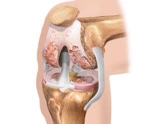 devre osteoartrit